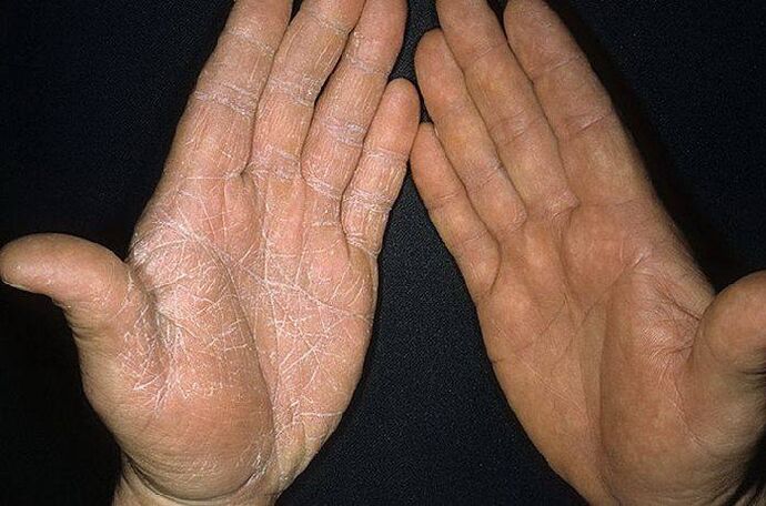 Symptomer vun engem Pilz op der Haut vun den Hänn